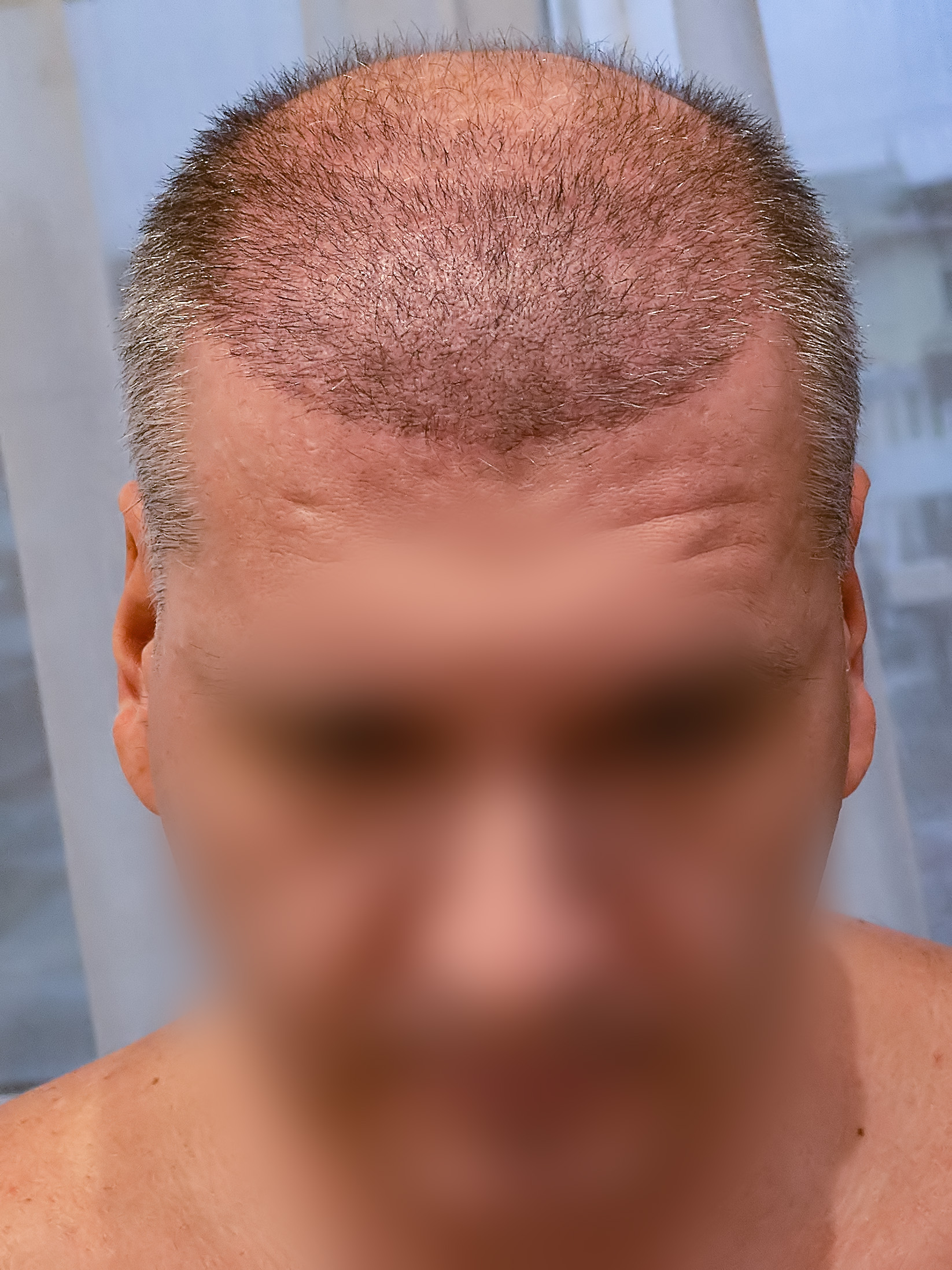 Пересадка волос красноярск