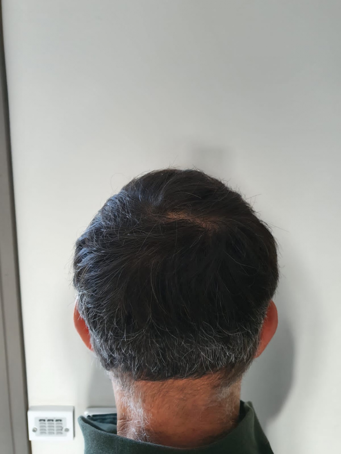 пересадка волос через год (12).jpeg