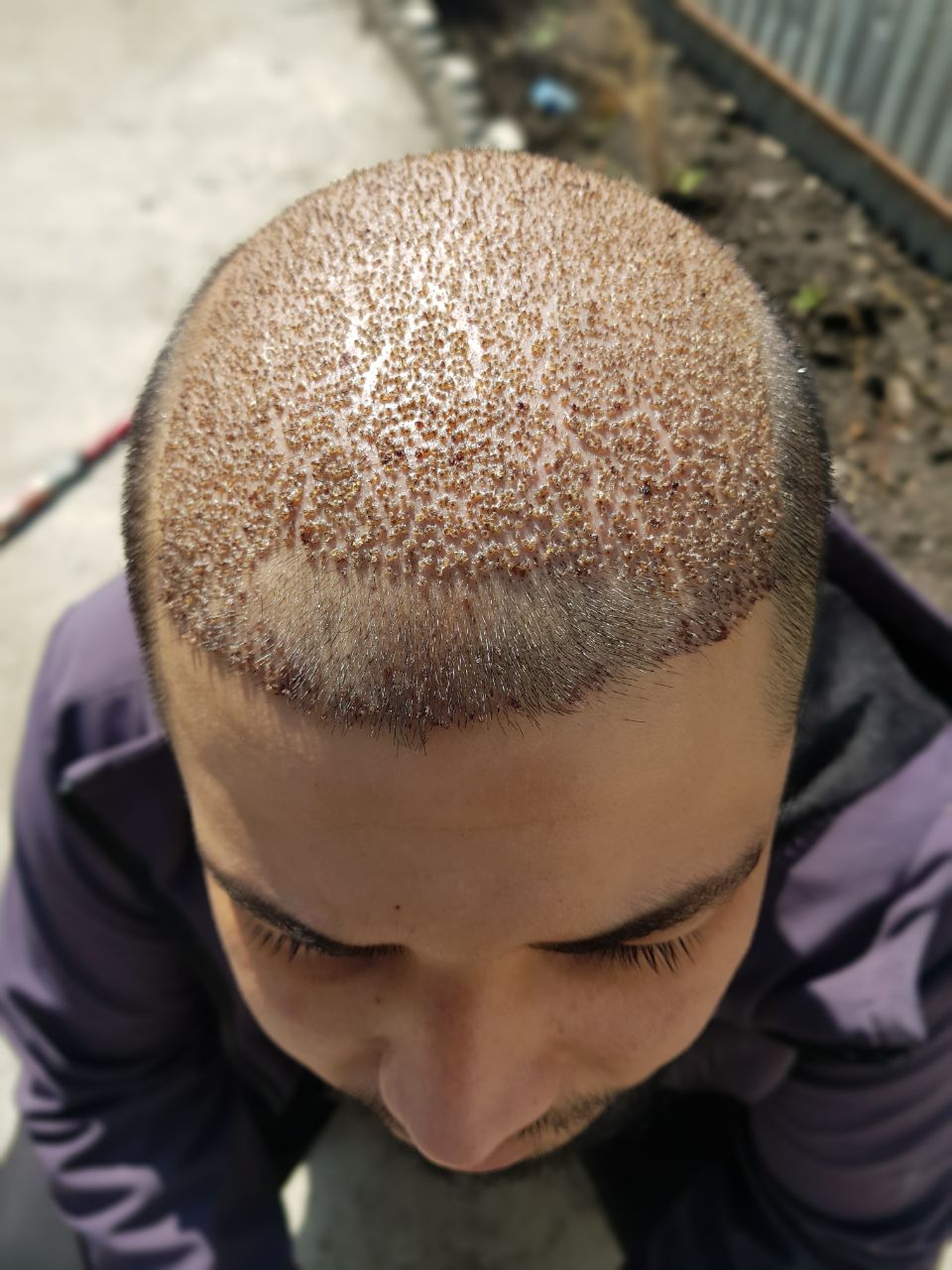 фото головы после пересадки волос