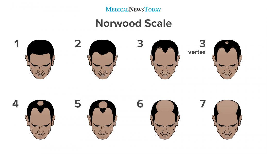 an-infographic-of-the-norwood-scale.jpg.465df545c1ac5a039edf64a4f8109364.jpg