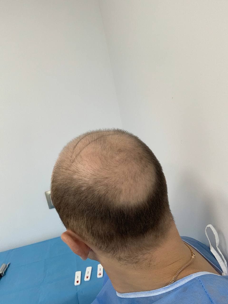 Пересадка волос в стамбуле. Доктор Бирджан пересадка волос. Голова после трансплантации волос. Мужчины после пересадки волос в Турции.