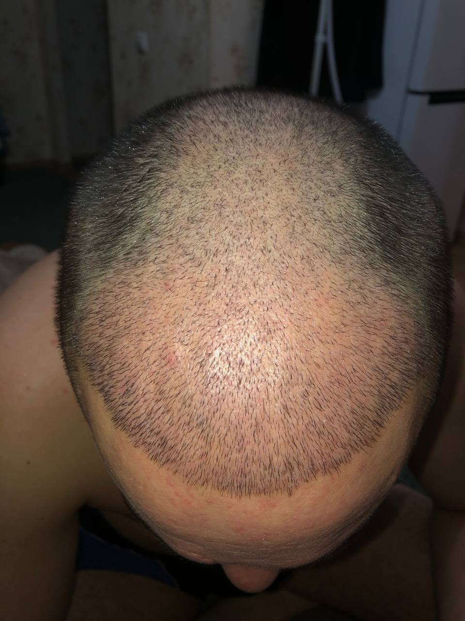 Месяц после пересадки волос