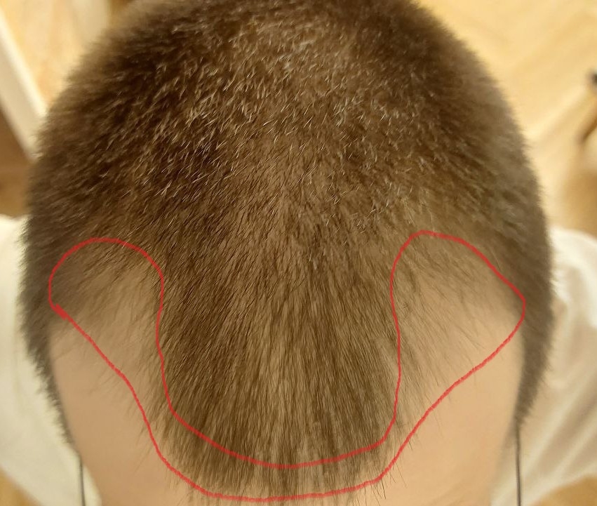 areafortransplantation.jpg.946735f0113a7a1d3dea78d4480f9522.jpg