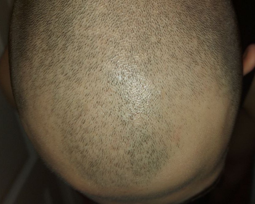 full_bald.jpg.7216b02bb207d17d3a343e4df68d84a2.jpg