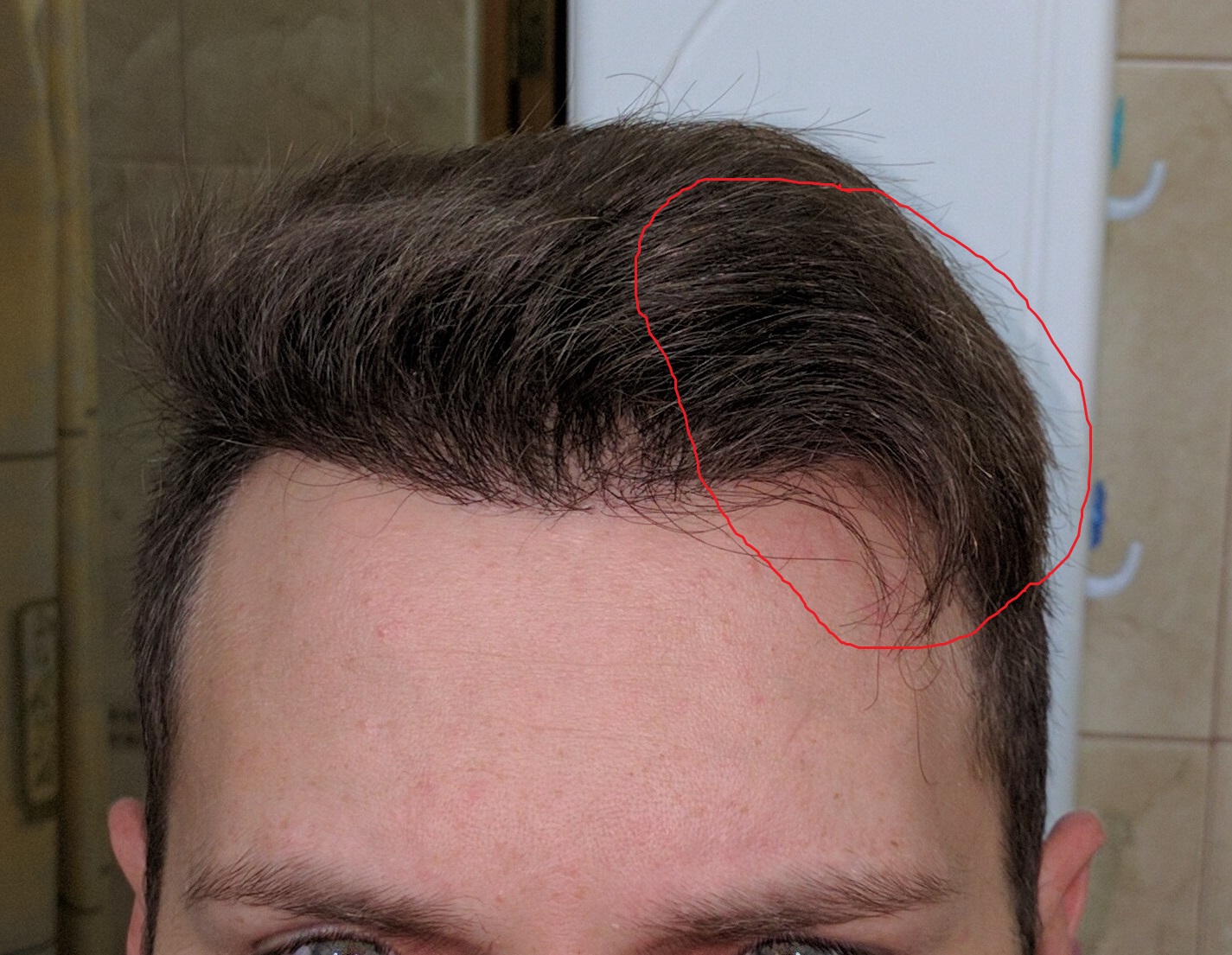 Пересадка волос в санкт петербурге. Передняя линия волос у мужчин. Нормальная линия волос.