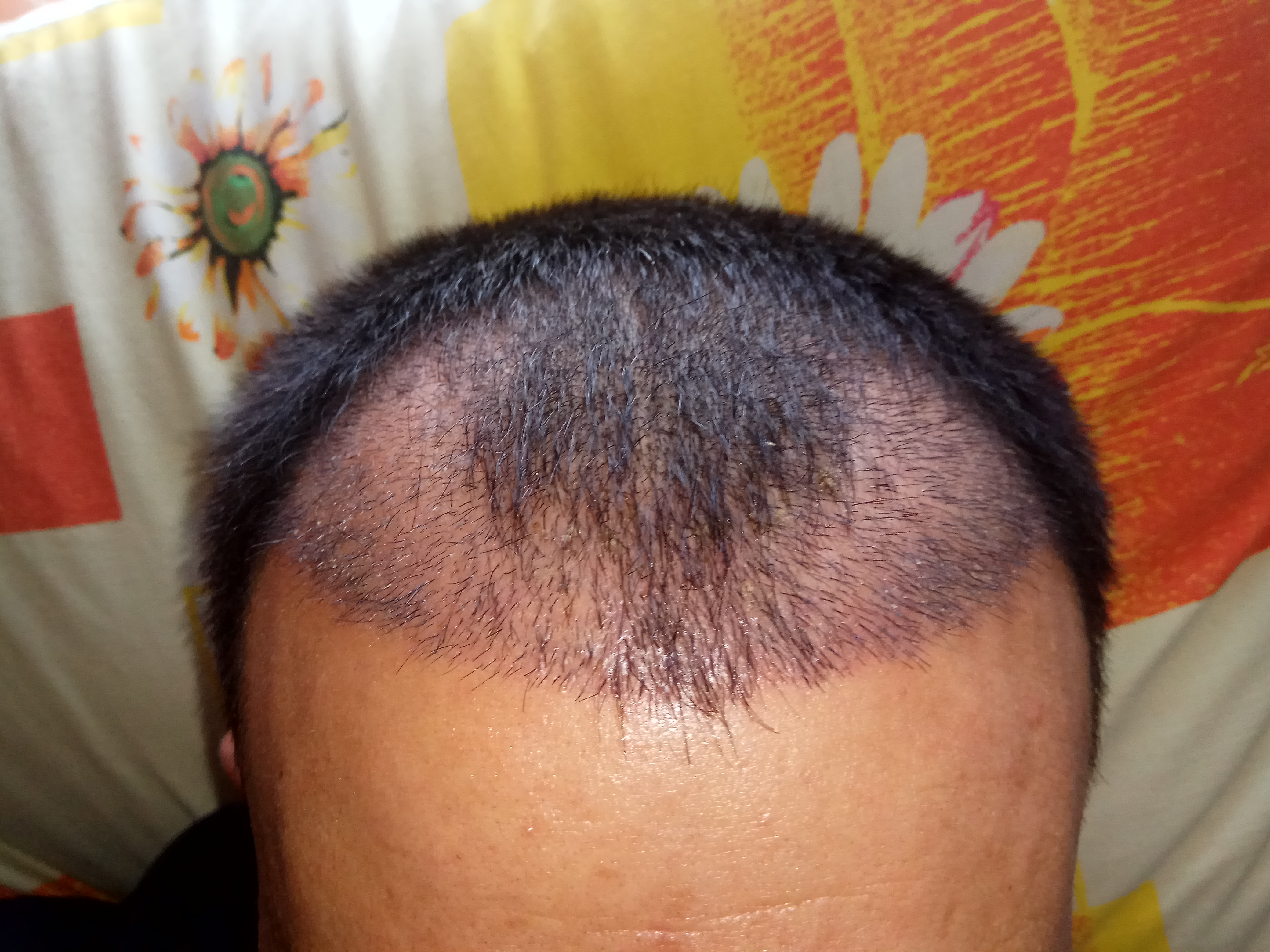 Пересадка волос донорская зона