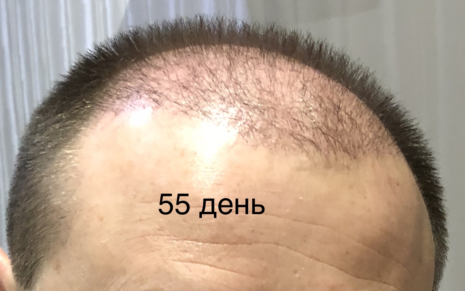 Пересадка волос через 10 дней