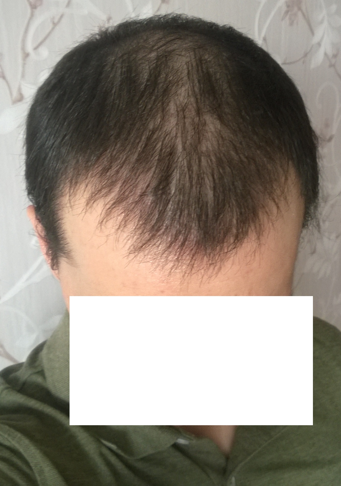 месяц после пересадки волос фото