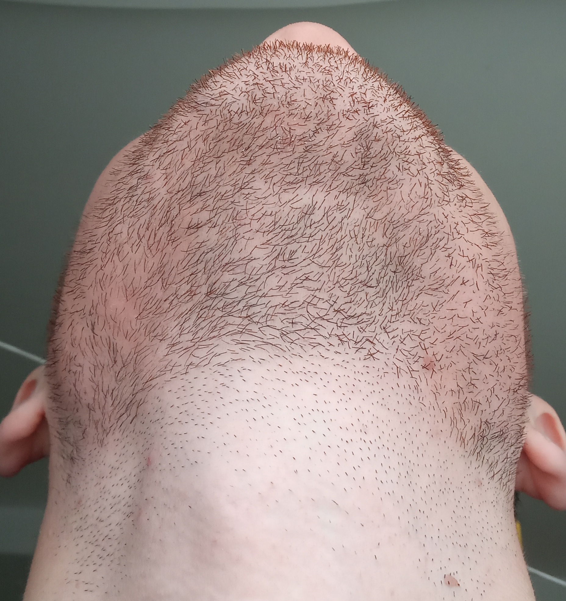 Можно ли пересадить волосы с бороды на голову
